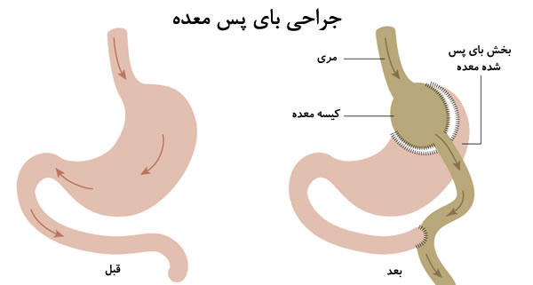 جراحي باي پس معده